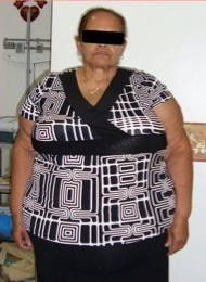 63 Year Old female treated for severe obesity before 1092443