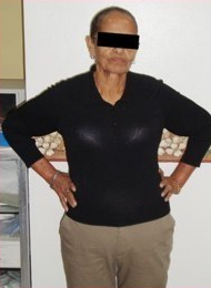 63 Year Old female treated for severe obesity after 1092443