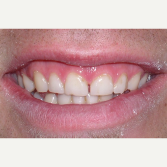 Gum surgery and six porcelain veneers. before 3448743