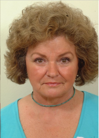 Lower facelift and eyelids after 120220
