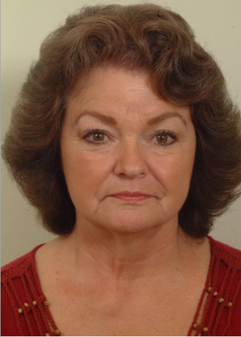 Lower facelift and eyelids before 120220