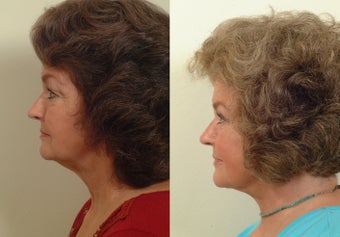 Lower facelift and eyelids 120220