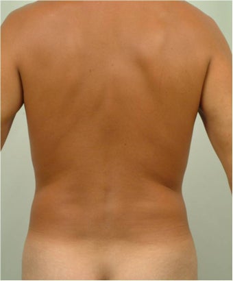 Laser Liposuction 459225