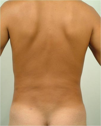 Laser Liposuction 459225