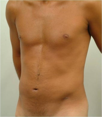 Laser Liposuction after 459225
