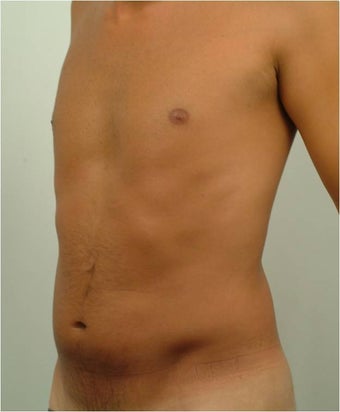 Laser Liposuction before 459225