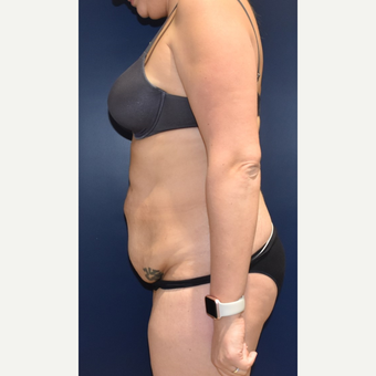 35-44 year old woman treated with Liposuction before 3489814