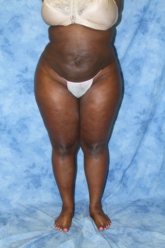 Liposuction works after 1285821