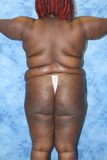 Liposuction works 1285821