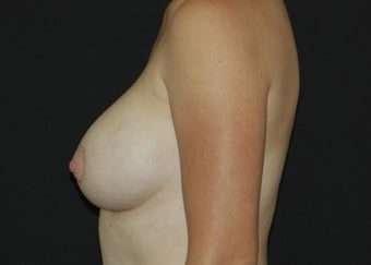 Breast Lift after 949212