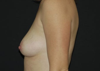 Breast Lift before 949212