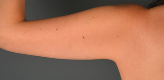 18-24 year old man treated with Vaser Liposuction after 2025460