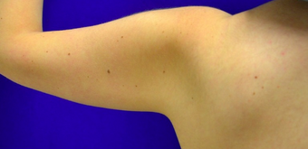 18-24 year old man treated with Vaser Liposuction before 2025460