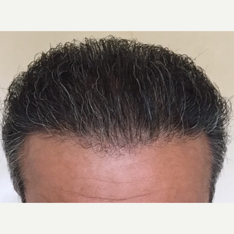 55-64 year old man treated with FUE Hair Transplant after 3080160