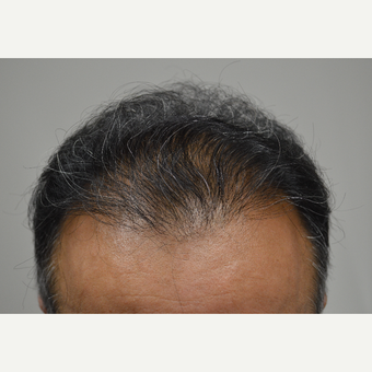 55-64 year old man treated with FUE Hair Transplant before 3080160