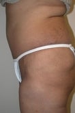 38 year old female patient 922927