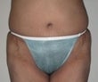 38 year old female patient after 922927