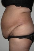 38 year old female patient 922927