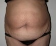 38 year old female patient before 922927