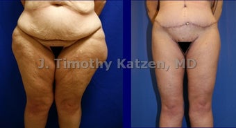 Leg Lift after weight loss surgery before 660699
