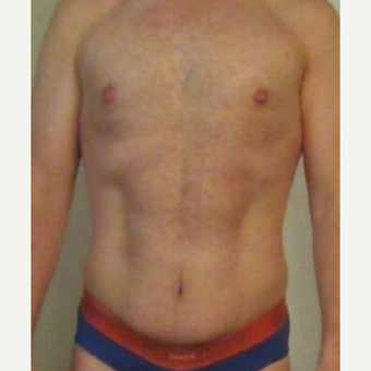 35-44 year old man treated with Mini Tummy Tuck and Liposuction chest, waist, back after 3848431