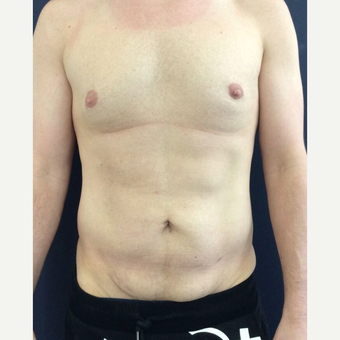 35-44 year old man treated with Mini Tummy Tuck and Liposuction chest, waist, back before 3848431
