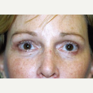 45-54 year old woman treated with Brow Lift after 3388808