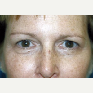 45-54 year old woman treated with Brow Lift before 3388808