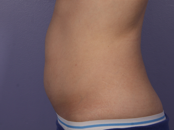CoolSculpting to Abdomen after 581864