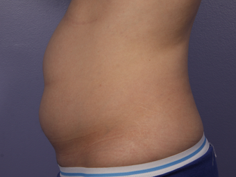 CoolSculpting to Abdomen before 581864
