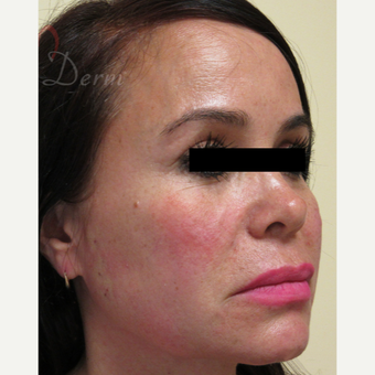 45-54 year old woman treated with Thread Lift in lower and mid-face after 3422116