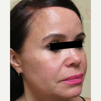 45-54 year old woman treated with Thread Lift in lower and mid-face before 3422116