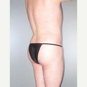35-44 year old man treated with Brazilian Butt Lift after 3814468
