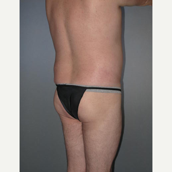 35-44 year old man treated with Brazilian Butt Lift before 3814468