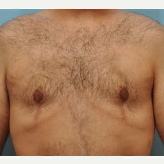 25-34 year old man treated with Male Breast Reduction after 3488233