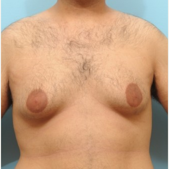 25-34 year old man treated with Male Breast Reduction before 3488233