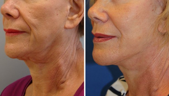 Mid Face Cheek Lift before 1360169