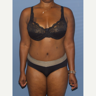 35-44 year old woman treated with Tummy Tuck after 3581251