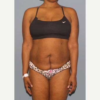 35-44 year old woman treated with Tummy Tuck before 3581251