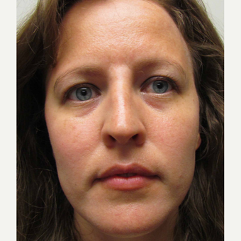 Non Surgical Nose Job for This 39 Year Old Woman after 3419761