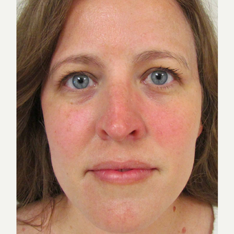 Non Surgical Nose Job for This 39 Year Old Woman before 3419761