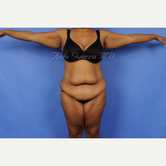 35-44 year old woman treated with Body Lift before 3805231