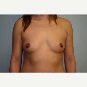 25-34 year old woman treated with Breast Augmentation before 3054296