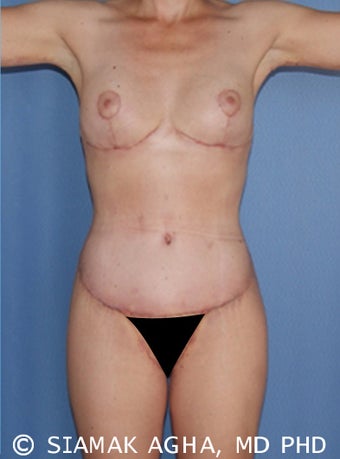 33 Year Old Female Body Lift after 660094