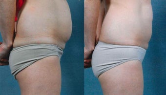 CoolSculpting Results before 1123917