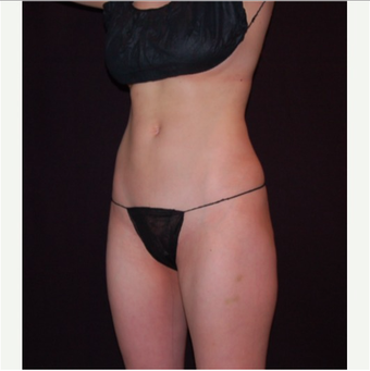 25-34 year old woman treated with CoolSculpting after 2339687
