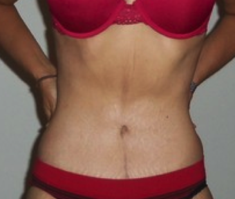 Complete Body Makeover after 1143516