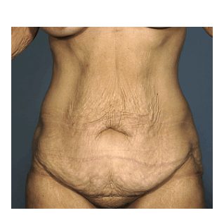 Complete Body Makeover before 1143516