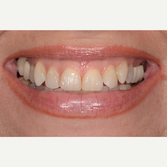 45-54 year old woman treated with Porcelain Veneers before 3732644