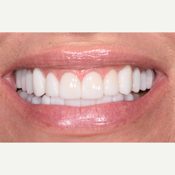 45-54 year old woman treated with Porcelain Veneers after 3732644